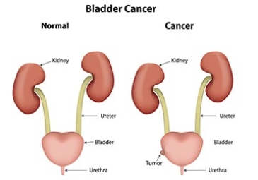 Bladder Surgery