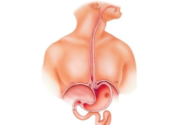 Esophageal