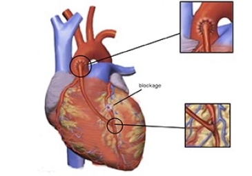 Heart Bypass Surgery