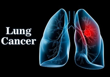 Lung Tumor Surgery