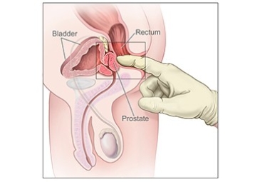 Prostate Surgery