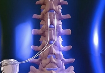 Spinal Cord Stimulator