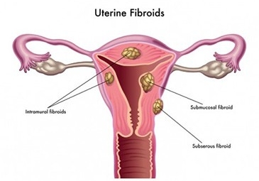 Abdominal Myomectomy