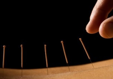 Acupuncture