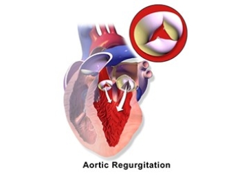 Aortic Valve Repair