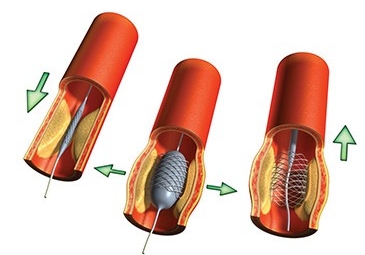 Balloon Angioplasty