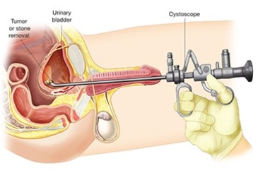 Bladder Stone Removal