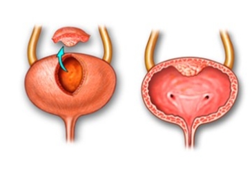 Cystectomy