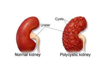 Cyst Unroofing or Decortication