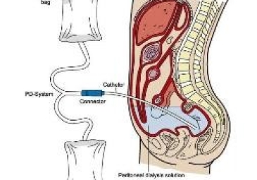 Peritoneal Dialysis (PD)