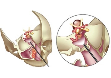 Minimally Invasive Endonasal Endoscopic Surgery