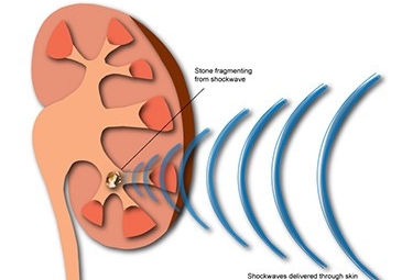 Extracorporeal Shock Wave Lithotripsy (ESWL or Lithotripsy)