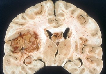 Glioma Brain Tumors