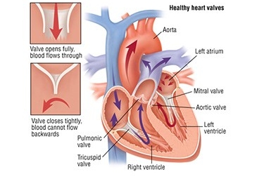 Heart Valve Replacement