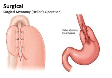 Heller Myotomy Procedure