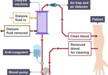 Hemodialysis (HD)