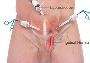 Laparoscopic Inguinal Hernia Repair