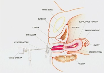 Hysteroscopic Myomectomy