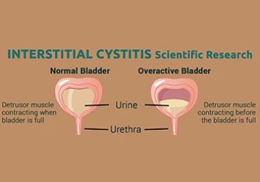 Interstitial Cystitis (Chronic Pelvic Pain Syndrome)