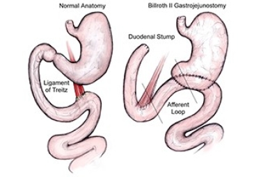 Laparoscopic Gastrectomy