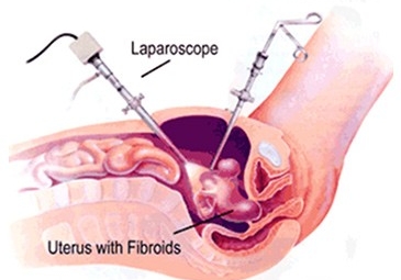 Laparoscopic Myomectomy