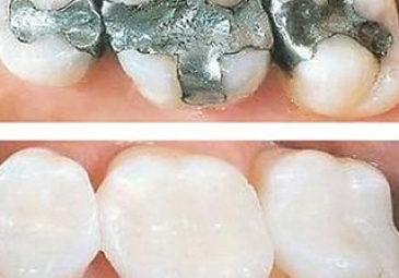 Laser Fillings