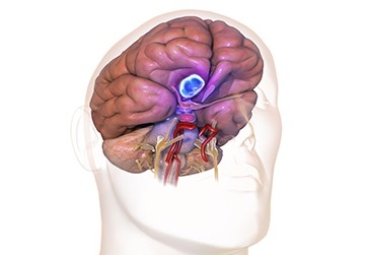 Meningioma Brain Tumors