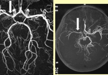 Moyamoya Disease