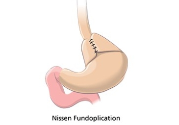 Nissen Fundoplication