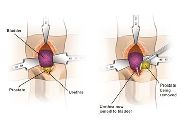 Open Prostatectomy