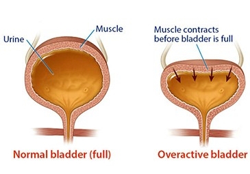 Overactive Bladder