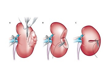 Partial Nephrectomy