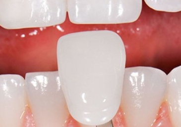 Porcelain Veneers