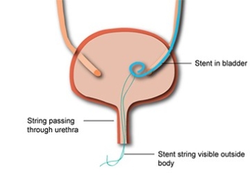 Pyeloplasty