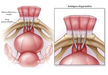 Retropubic Suspension