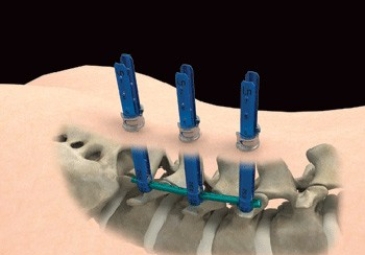 Minimally Invasive Percutaneous Posterior Pedicle Screw Fixation