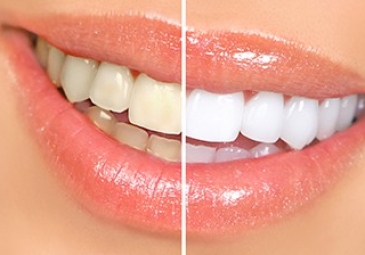 Teeth Bleaching