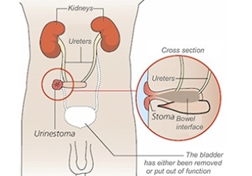 Total Cystectomy