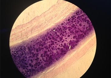 Tracheal Dilation