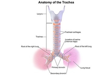 Tracheal Resection