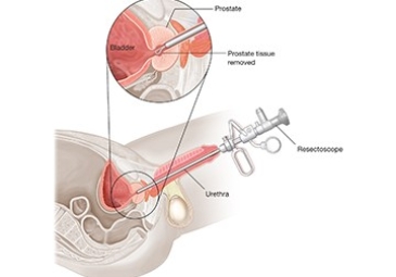 Transurethral Resecion