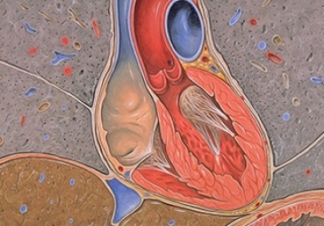 Tricuspid Valve Repair