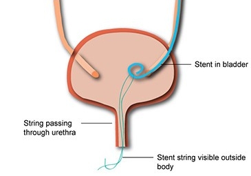 Urethral Stent Placement