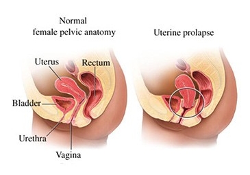 Uterine Prolapse Surgery