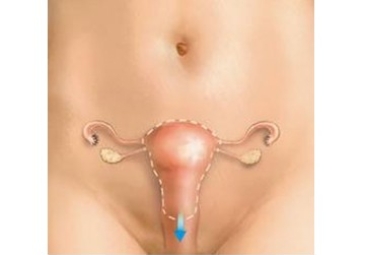 Vaginal Hysterectomy