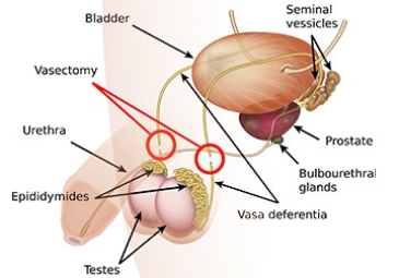 Vasectomy