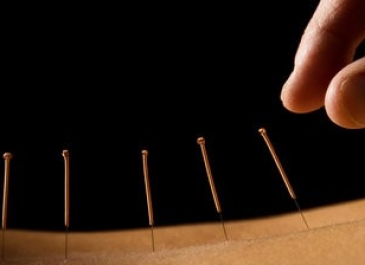 Acupuncture