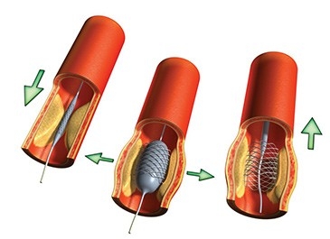 Balloon Angioplasty