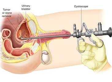 Bladder Stone Removal