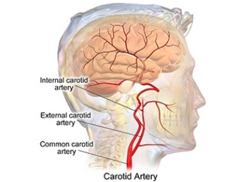 Carotid Stenosis (Carotid Artery Disease)